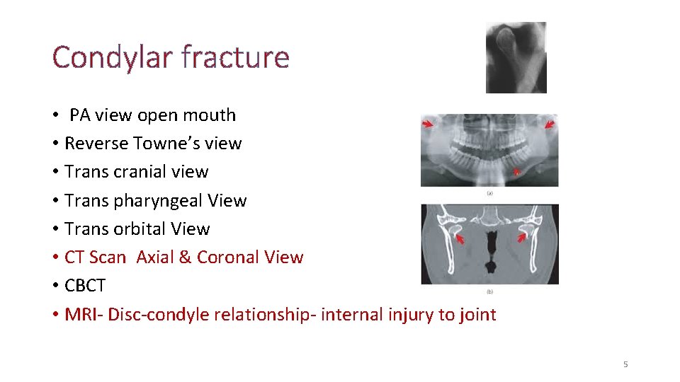 Condylar fracture • PA view open mouth • Reverse Towne’s view • Trans cranial