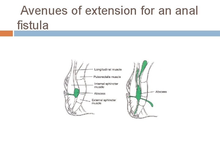 Avenues of extension for an anal fistula 