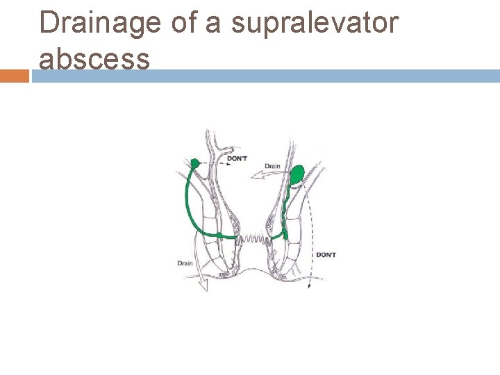 Drainage of a supralevator abscess 