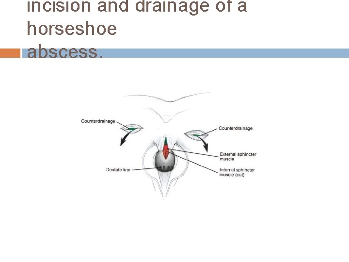 incision and drainage of a horseshoe abscess. 