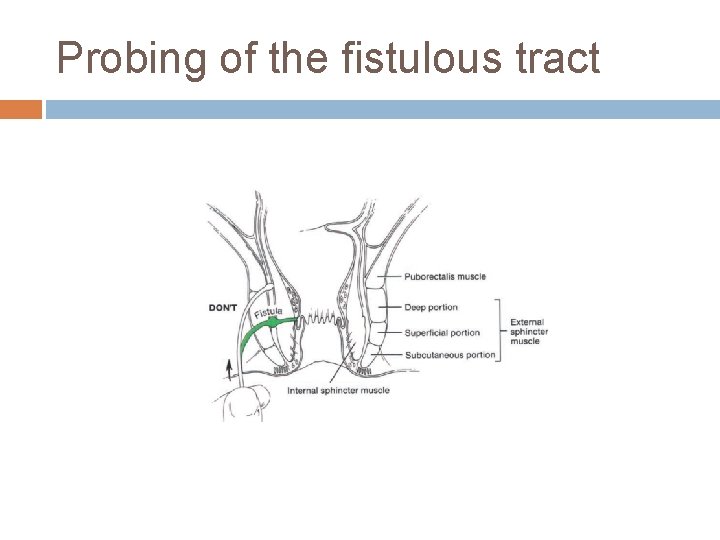 Probing of the fistulous tract 