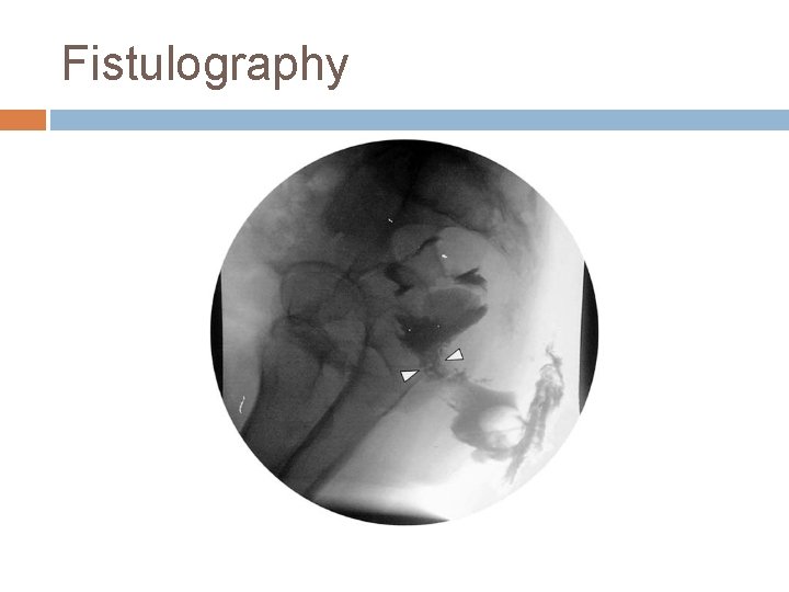 Fistulography 