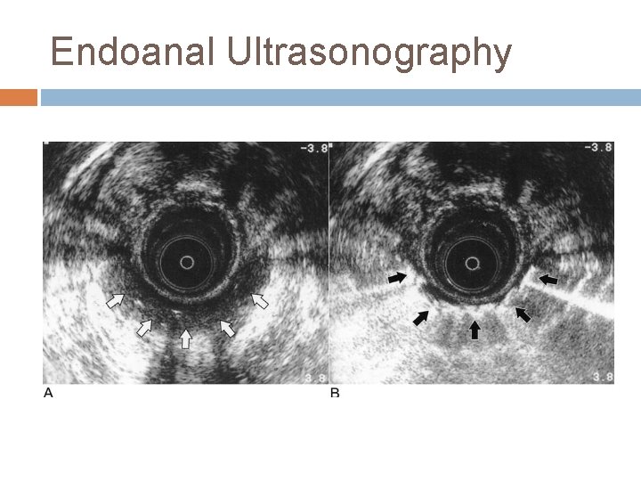 Endoanal Ultrasonography 