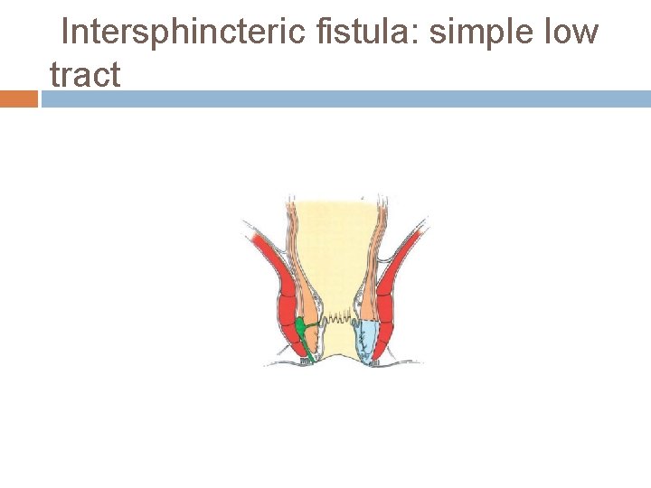 Intersphincteric fistula: simple low tract 