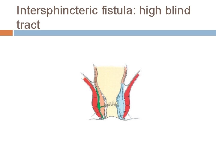 Intersphincteric fistula: high blind tract 