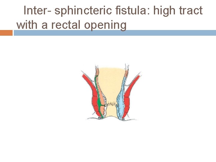 Inter- sphincteric fistula: high tract with a rectal opening 