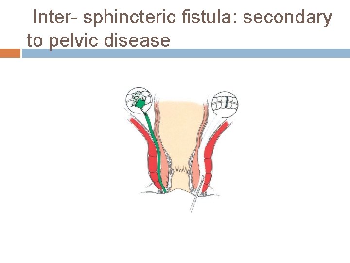 Inter- sphincteric fistula: secondary to pelvic disease 