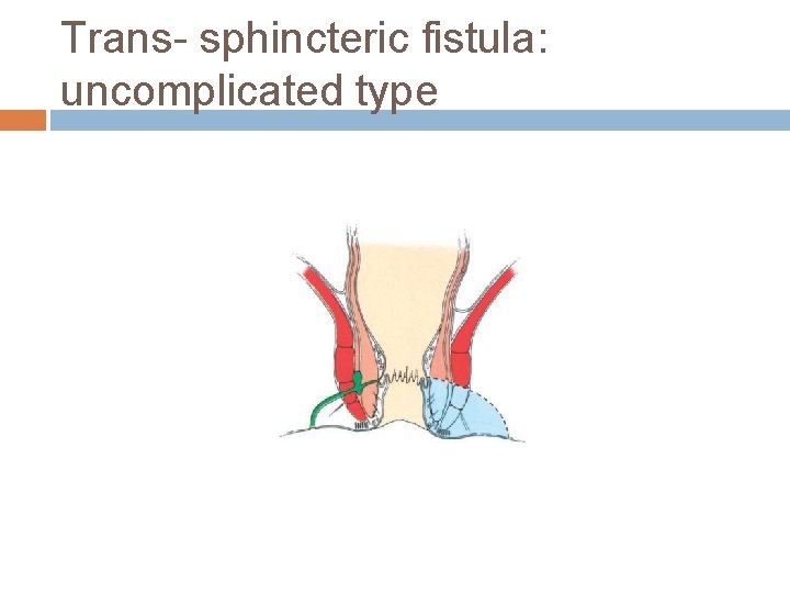 Trans- sphincteric fistula: uncomplicated type 