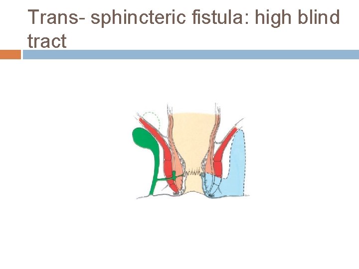 Trans- sphincteric fistula: high blind tract 