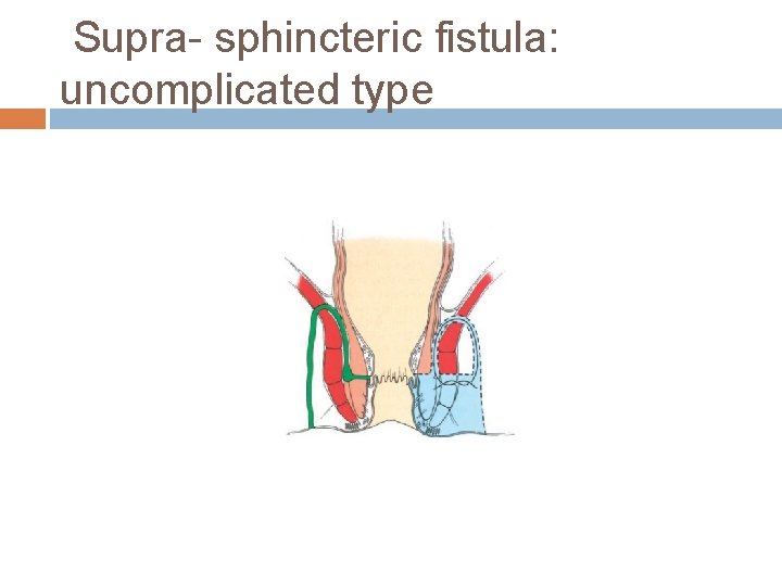 Supra- sphincteric fistula: uncomplicated type 