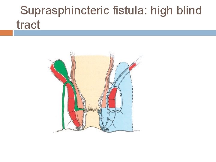 Suprasphincteric fistula: high blind tract 