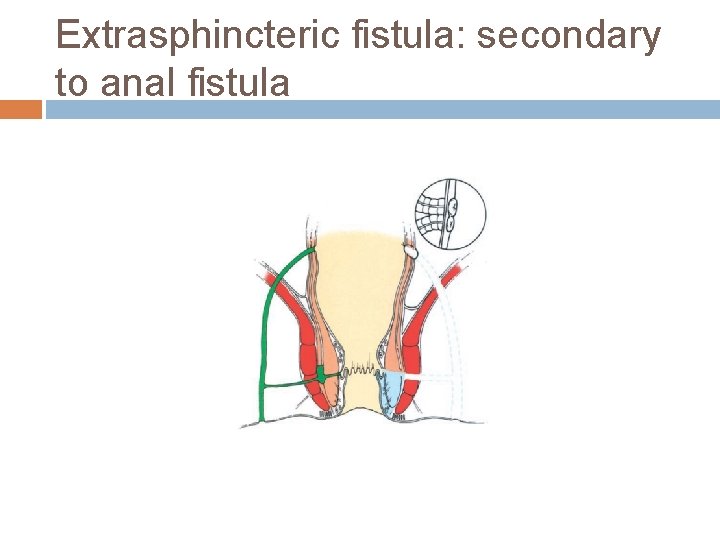 Extrasphincteric fistula: secondary to anal fistula 