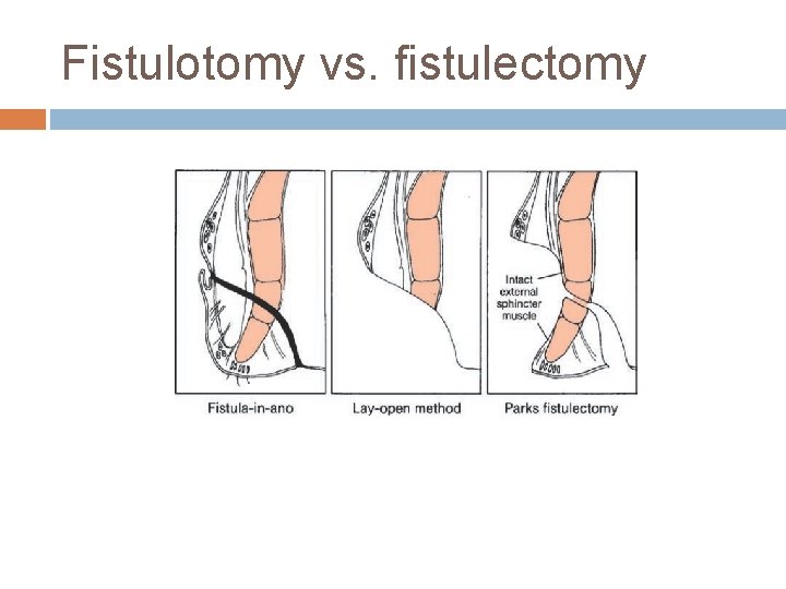 Fistulotomy vs. fistulectomy 