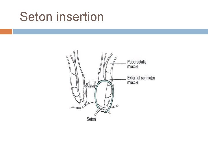 Seton insertion 