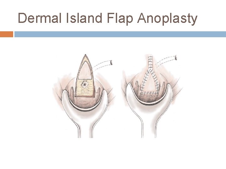 Dermal Island Flap Anoplasty 