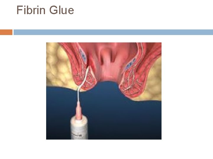 Fibrin Glue 