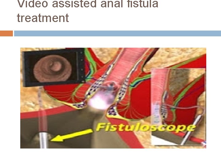 Video assisted anal fistula treatment 