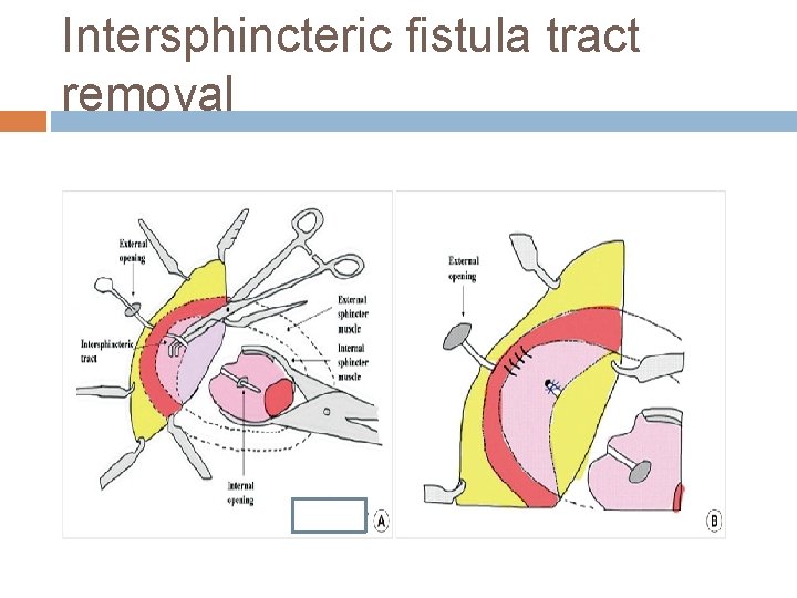 Intersphincteric fistula tract removal 