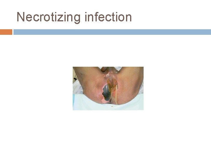 Necrotizing infection 