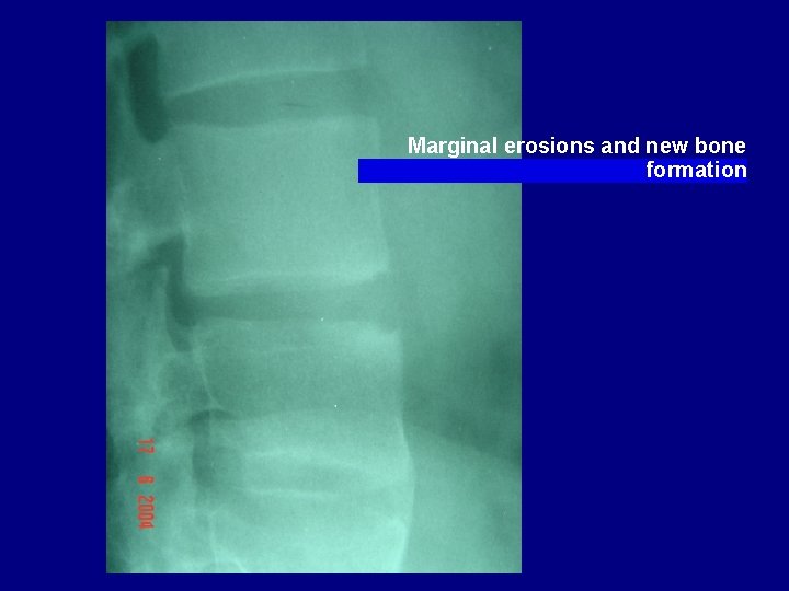 Marginal erosions and new bone formation 