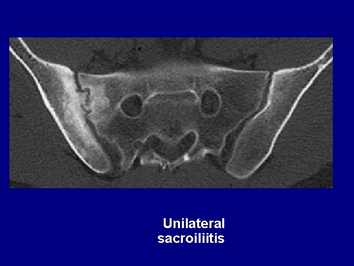 Unilateral sacroiliitis 