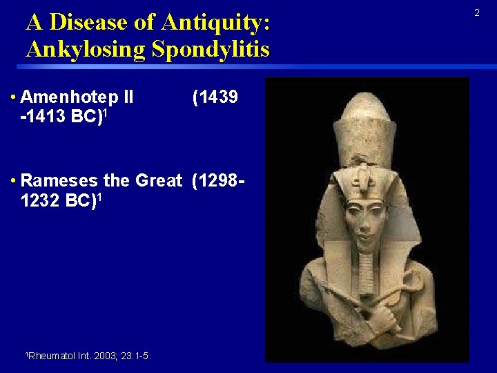 A Disease of Antiquity: Ankylosing Spondylitis • Amenhotep II (1439 -1413 BC)1 • Rameses