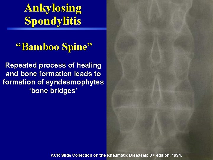 Ankylosing Spondylitis “Bamboo Spine” Repeated process of healing and bone formation leads to formation