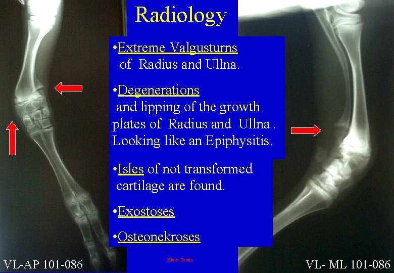 Radiology • Extreme Valgusturns of Radius and Ullna. • Degenerations and lipping of the