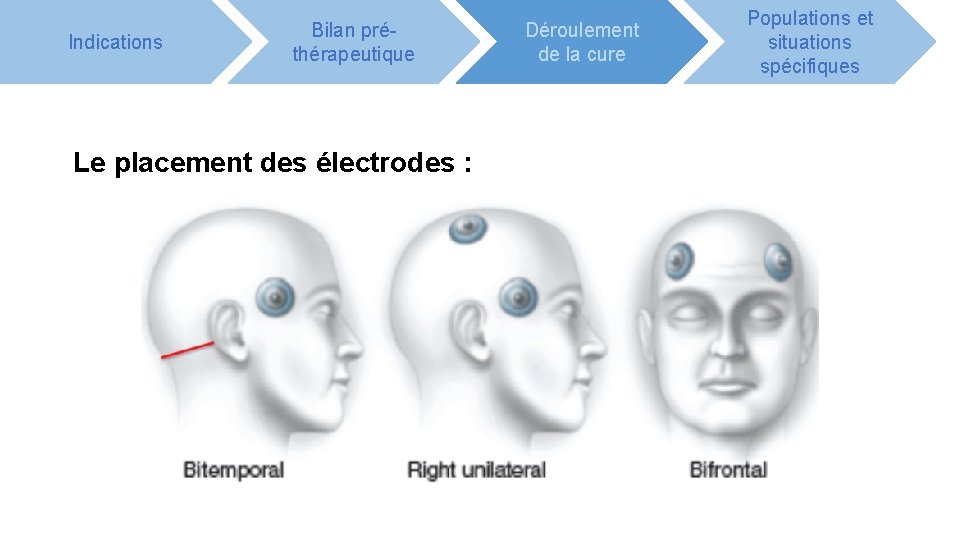 Indications Bilan préthérapeutique Le placement des électrodes : Déroulement de la cure Populations et