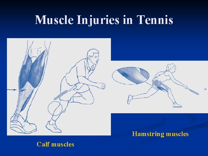 Muscle Injuries in Tennis Hamstring muscles Calf muscles 