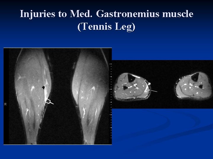 Injuries to Med. Gastronemius muscle (Tennis Leg) 