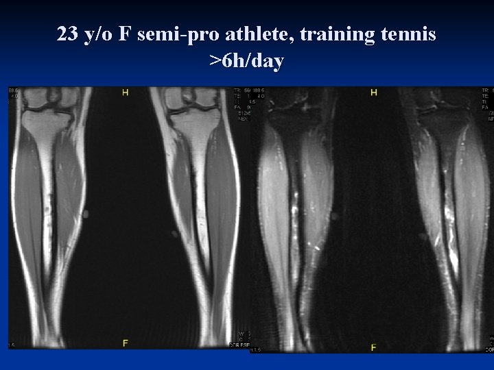 23 y/o F semi-pro athlete, training tennis >6 h/day 