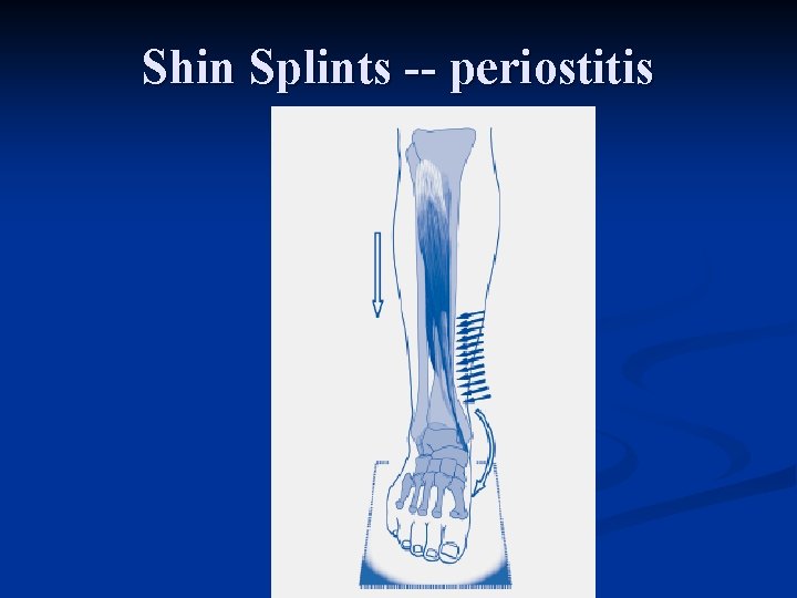 Shin Splints -- periostitis 