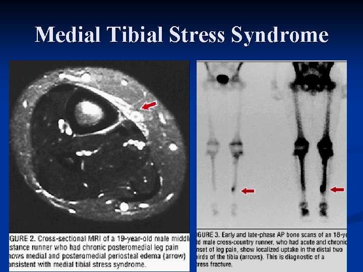 Medial Tibial Stress Syndrome 