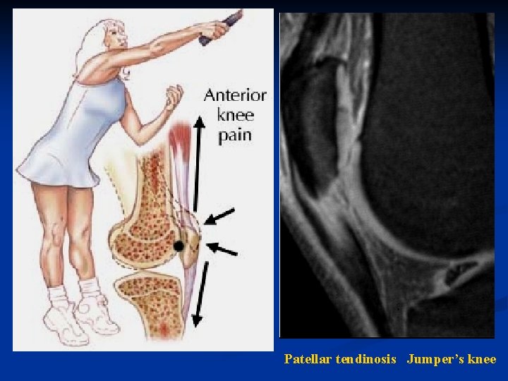 Patellar tendinosis Jumper’s knee 