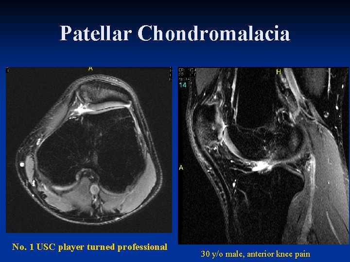 Patellar Chondromalacia No. 1 USC player turned professional 30 y/o male, anterior knee pain