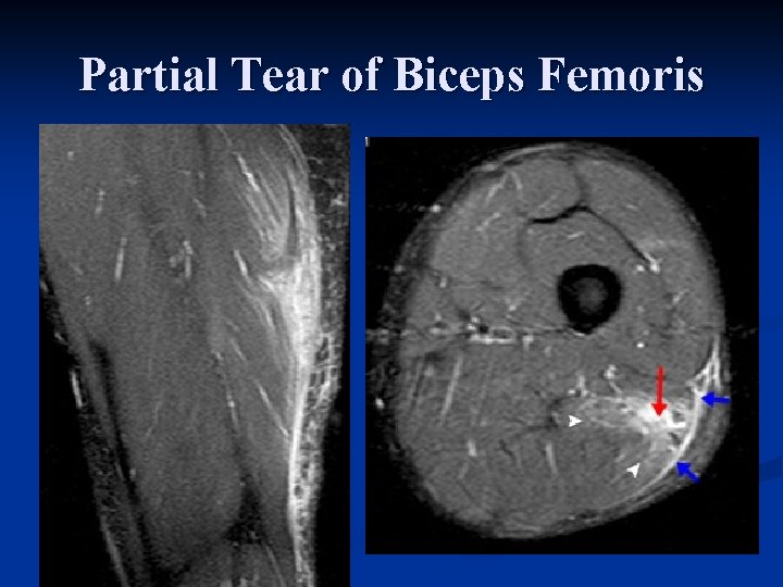 Partial Tear of Biceps Femoris 