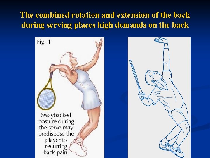 The combined rotation and extension of the back during serving places high demands on