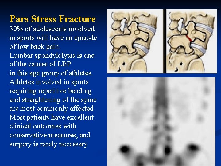 Pars Stress Fracture 30% of adolescents involved in sports will have an episode of