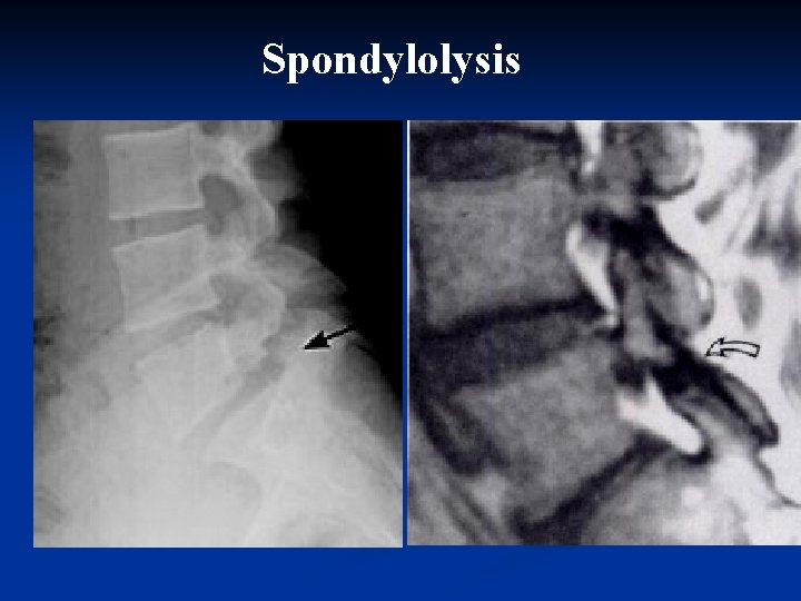 Spondylolysis 