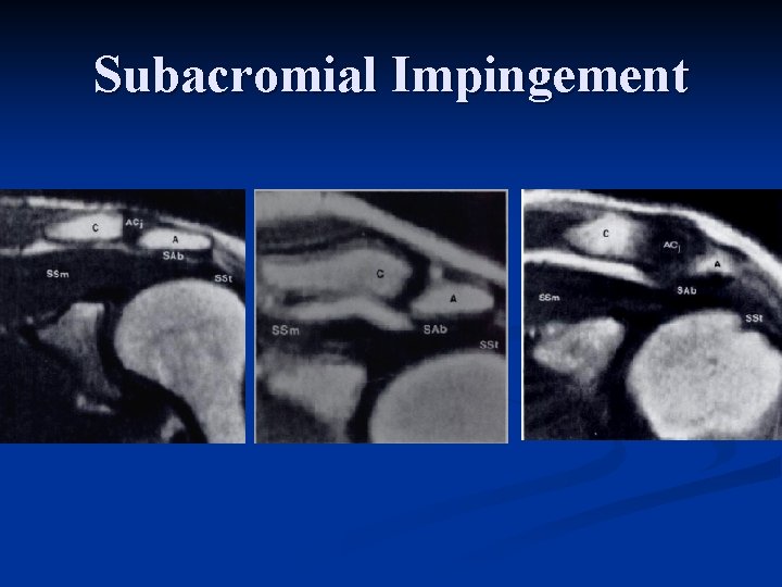 Subacromial Impingement 