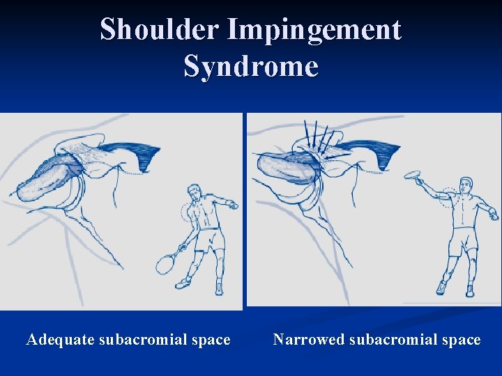 Shoulder Impingement Syndrome Adequate subacromial space Narrowed subacromial space 