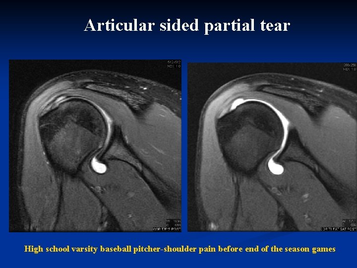 Articular sided partial tear High school varsity baseball pitcher-shoulder pain before end of the