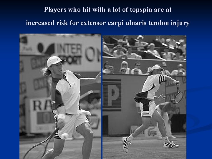 Players who hit with a lot of topspin are at increased risk for extensor