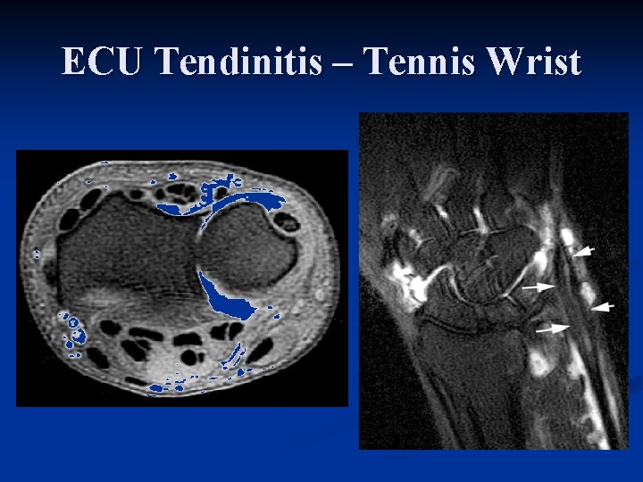 ECU Tendinitis – Tennis Wrist 