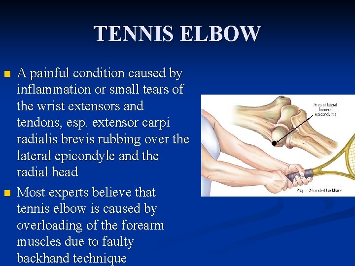 TENNIS ELBOW n n A painful condition caused by inflammation or small tears of