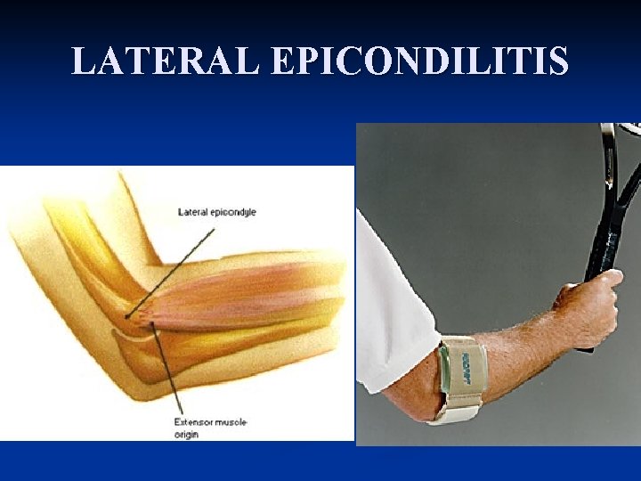 LATERAL EPICONDILITIS 