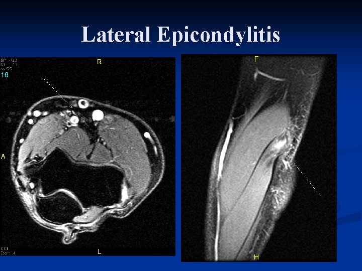 Lateral Epicondylitis 