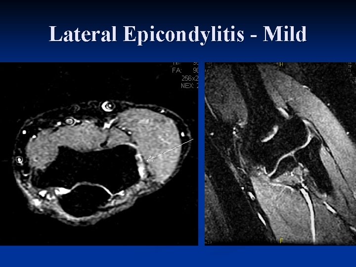 Lateral Epicondylitis - Mild 