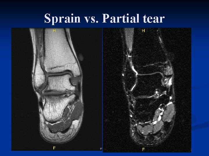 Sprain vs. Partial tear 